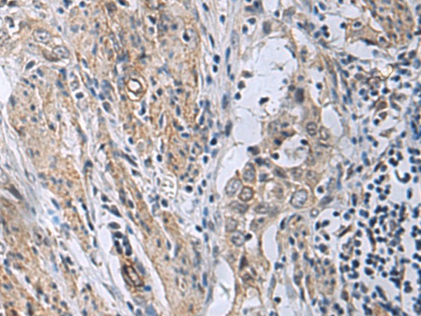 Immunohistochemistry of paraffin-embedded Human esophagus cancer tissue  using MBL2 Polyclonal Antibody at dilution of 1:25(?200)