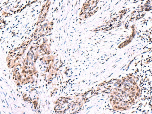 Immunohistochemistry of paraffin-embedded Human esophagus cancer tissue  using POLD2 Polyclonal Antibody at dilution of 1:95(?200)