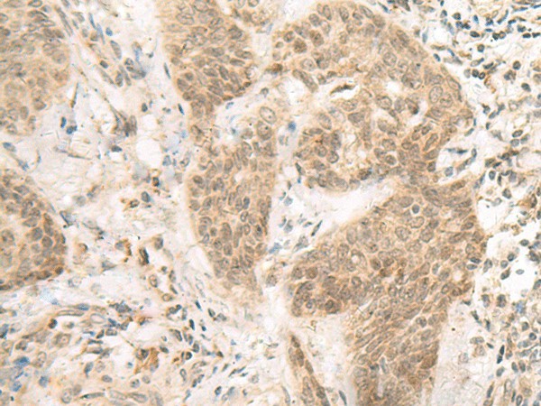 Immunohistochemistry of paraffin-embedded Human esophagus cancer tissue  using FERD3L Polyclonal Antibody at dilution of 1:85(?200)