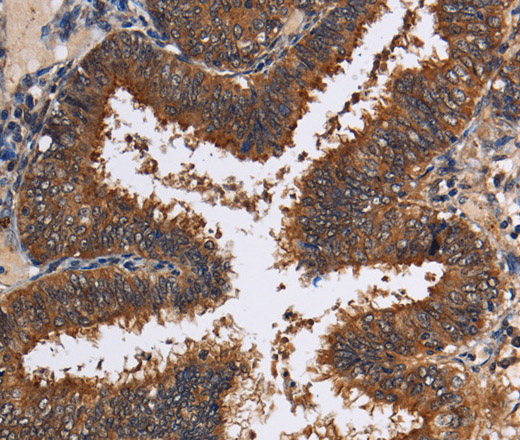 Immunohistochemistry of paraffin-embedded Human colon cancer tissue using LRRC57 Polyclonal Antibody at dilution 1:40