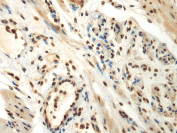 Immunohistochemistry of paraffin-embedded Human thyroid cancer tissue  using DDX39A Polyclonal Antibody at dilution of 1:70(?200)