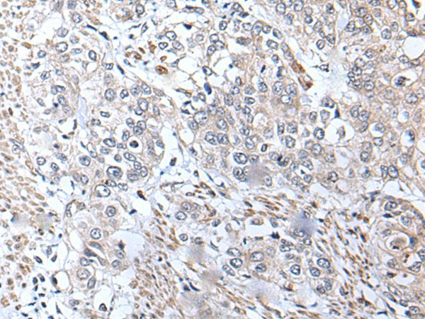 Immunohistochemistry of paraffin-embedded Human prost ate cancer tissue  using METTL7A Polyclonal Antibody at dilution of 1:40(?200)