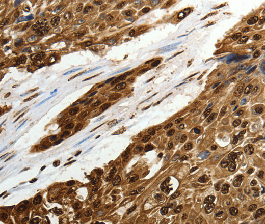 Immunohistochemistry of paraffin-embedded Human esophagus cancer tissue using SCN1A Polyclonal Antibody at dilution 1:50