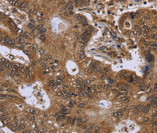 Immunohistochemistry of paraffin-embedded Human colon cancer using FHIT Polyclonal Antibody at dilution of 1:30