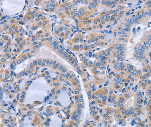 Immunohistochemistry of paraffin-embedded Human thyroid cancer using CD36 Polyclonal Antibody at dilution of 1:60