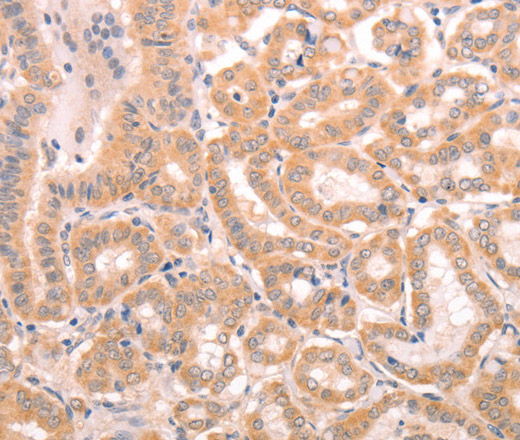 Immunohistochemistry of paraffin-embedded Human thyroid cancer tissue using TRPC3 Polyclonal Antibody at dilution 1:50