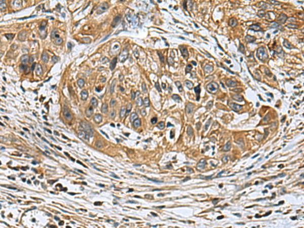 Immunohistochemistry of paraffin-embedded Human esophagus cancer tissue  using EARS2 Polyclonal Antibody at dilution of 1:30(?200)