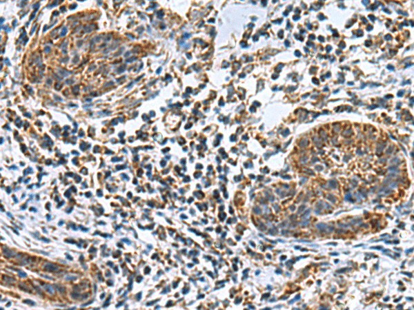 Immunohistochemistry of paraffin-embedded Human esophagus cancer tissue  using MRPL40 Polyclonal Antibody at dilution of 1:80(?200)