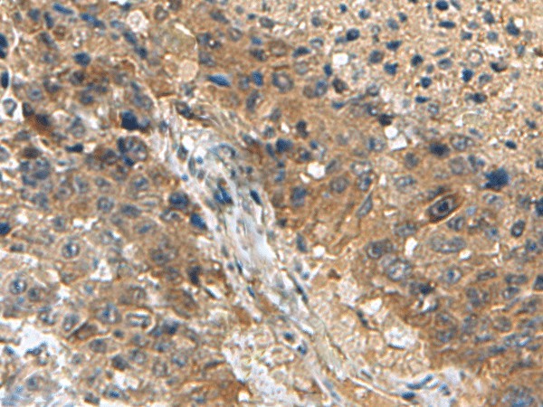 Immunohistochemistry of paraffin-embedded Human liver cancer tissue  using TPD52L3 Polyclonal Antibody at dilution of 1:140(?200)