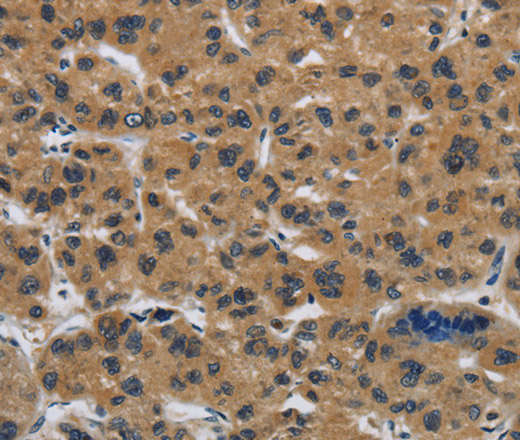 Immunohistochemistry of paraffin-embedded Human liver cancer tissue using Claudin 2 Polyclonal Antibody at dilution 1:50