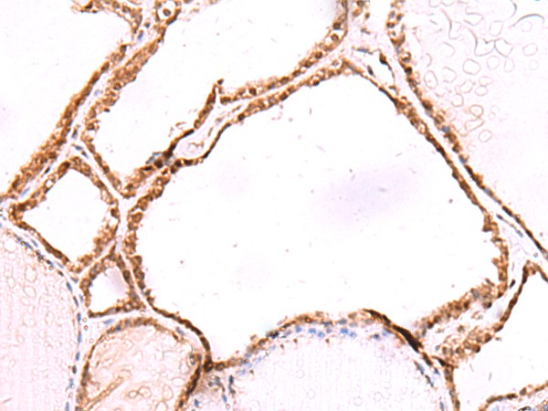 Immunohistochemistry of paraffin-embedded Human thyroid cancer tissue  using LMCD1 Polyclonal Antibody at dilution of 1:80(?200)