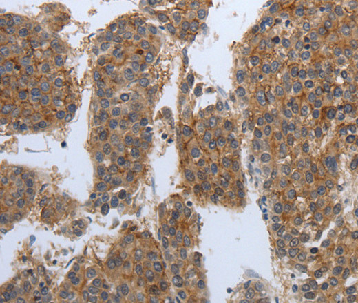 Immunohistochemistry of paraffin-embedded Human liver cancer tissue using PDIA2 Polyclonal Antibody at dilution 1:50