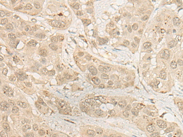 Immunohistochemistry of paraffin-embedded Human esophagus cancer tissue  using RSU1 Polyclonal Antibody at dilution of 1:30(?200)