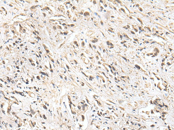 Immunohistochemistry of paraffin-embedded Human prost ate cancer tissue  using ZNF281 Polyclonal Antibody at dilution of 1:30(?200)