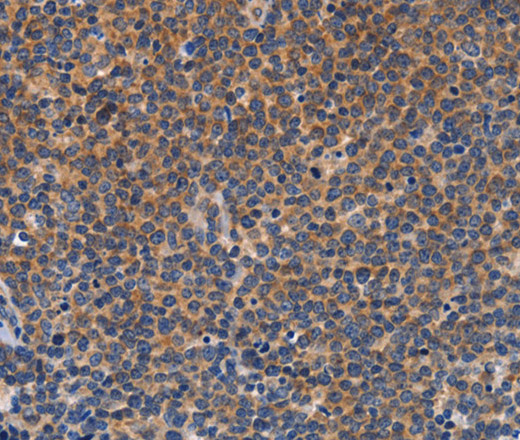 Immunohistochemistry of paraffin-embedded Human Lymphoma tissue using CCL23 Polyclonal Antibody at dilution 1:50