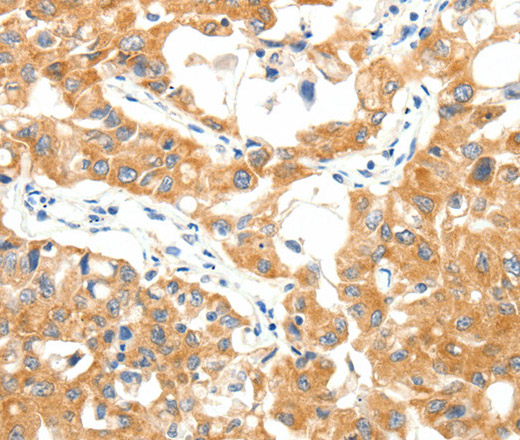 Immunohistochemistry of paraffin-embedded Human lung cancer using TRAF3 Polyclonal Antibody at dilution of 1:40