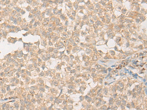 Immunohistochemistry of paraffin-embedded Human ovarian cancer tissue  using PPM1D Polyclonal Antibody at dilution of 1:60(?200)