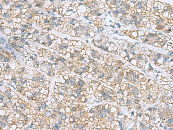 Immunohistochemistry of paraffin-embedded Human liver cancer tissue  using NANP Polyclonal Antibody at dilution of 1:50(?200)