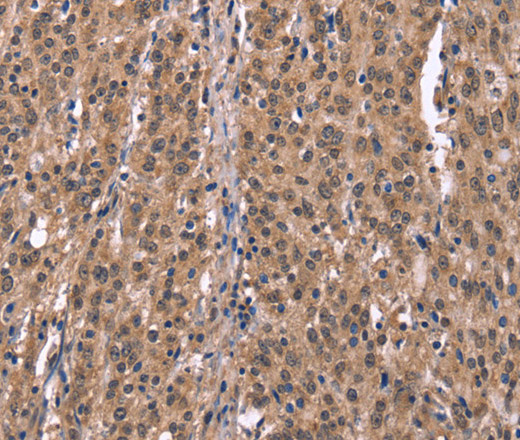 Immunohistochemistry of paraffin-embedded Human gastric cancer using Histamine H1 Receptor Polyclonal Antibody at dilution of 1:40