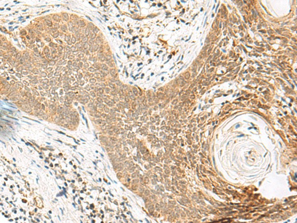 Immunohistochemistry of paraffin-embedded Human esophagus cancer tissue  using ORC4 Polyclonal Antibody at dilution of 1:80(?200)