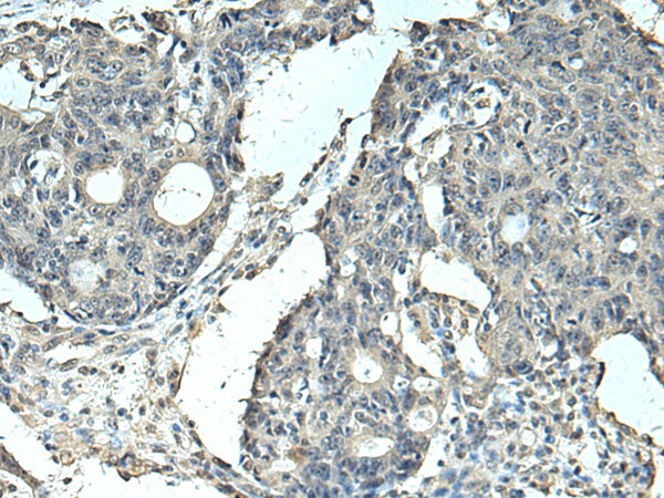 Immunohistochemistry of paraffin-embedded Human colorectal cancer tissue  using SLC35F6 Polyclonal Antibody at dilution of 1:95(?200)