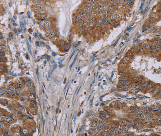 Immunohistochemistry of paraffin-embedded Human esophagus cancer tissue using NOX3 Polyclonal Antibody at dilution 1:40