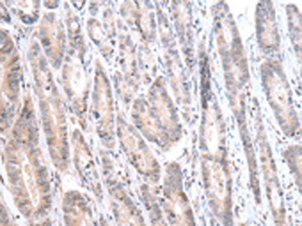 Immunohistochemistry of paraffin-embedded Human gastric cancer tissue  using CALB2 Polyclonal Antibody at dilution of 1:25(?200)