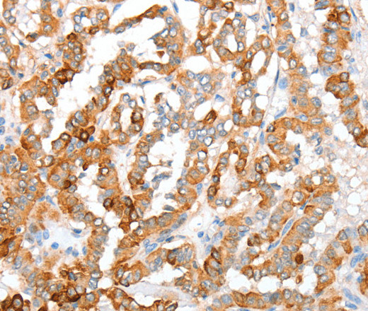 Immunohistochemistry of paraffin-embedded Human thyroid cancer using ACY3 Polyclonal Antibody at dilution of 1:35