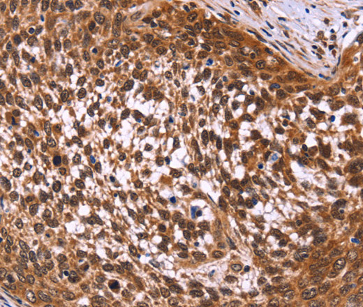 Immunohistochemistry of paraffin-embedded Human cervical cancer tissue using MSH4 Polyclonal Antibody at dilution 1:50