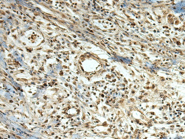 Immunohistochemistry of paraffin-embedded Human breast cancer tissue  using MLF1 Polyclonal Antibody at dilution of 1:105(?200)