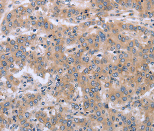 Immunohistochemistry of paraffin-embedded Human liver cancer using ECE1 Polyclonal Antibody at dilution of 1:30