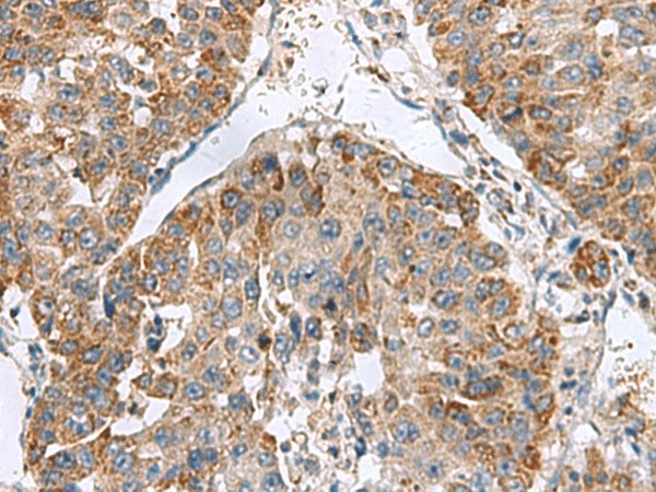 Immunohistochemistry of paraffin-embedded Human liver cancer tissue  using NFS1 Polyclonal Antibody at dilution of 1:50(?200)