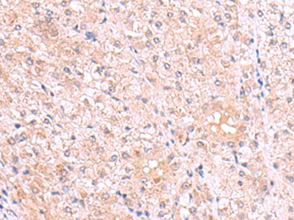 Immunohistochemistry of paraffin-embedded Human liver cancer tissue  using PISD Polyclonal Antibody at dilution of 1:80(?200)