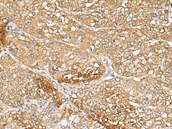 Immunohistochemistry of paraffin-embedded Human liver cancer tissue  using C1orf112 Polyclonal Antibody at dilution of 1:110(?200)