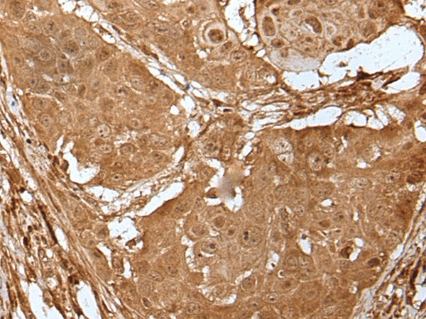 Immunohistochemistry of paraffin-embedded Human esophagus cancer tissue  using LIPG Polyclonal Antibody at dilution of 1:50(?200)