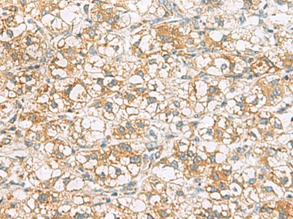 Immunohistochemistry of paraffin-embedded Human liver cancer tissue  using TLE6 Polyclonal Antibody at dilution of 1:75(?200)