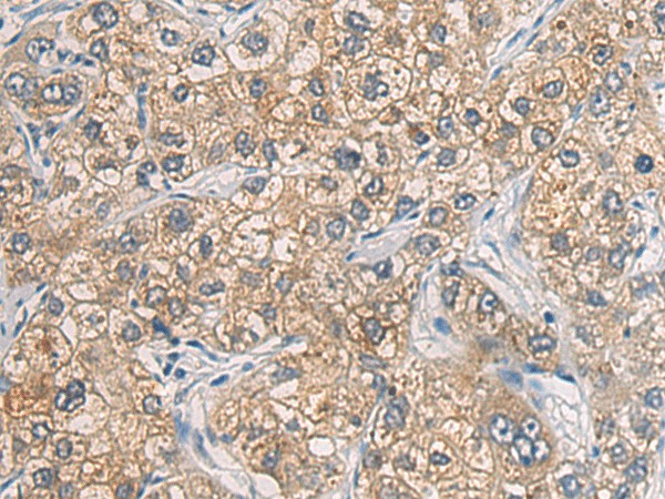 Immunohistochemistry of paraffin-embedded Human liver cancer tissue  using GAB4 Polyclonal Antibody at dilution of 1:60(?200)