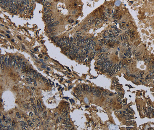 Immunohistochemistry of paraffin-embedded Human colon cancer using GSTO1 Polyclonal Antibody at dilution of 1:60