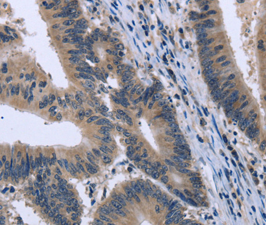 Immunohistochemistry of paraffin-embedded Human colon cancer tissue using KCNJ11 Polyclonal Antibody at dilution 1:40