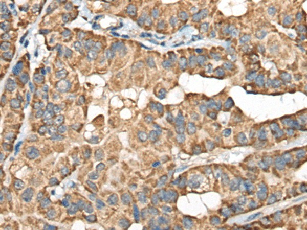 Immunohistochemistry of paraffin-embedded Human thyroid cancer tissue  using BLNK Polyclonal Antibody at dilution of 1:40(?200)