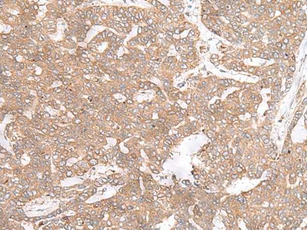 Immunohistochemistry of paraffin-embedded Human liver cancer tissue  using PTP4A3 Polyclonal Antibody at dilution of 1:40(?200)