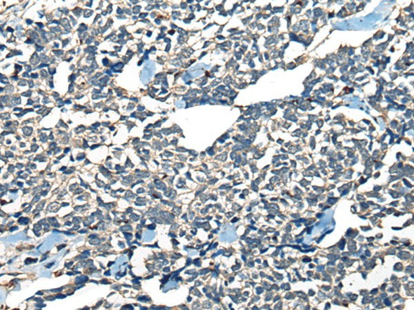 Immunohistochemistry of paraffin-embedded Human lung cancer tissue  using CDADC1 Polyclonal Antibody at dilution of 1:60(?200)