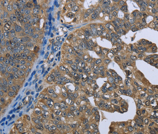 Immunohistochemistry of paraffin-embedded Human ovarian cancer tissue using GPAM Polyclonal Antibody at dilution 1:60