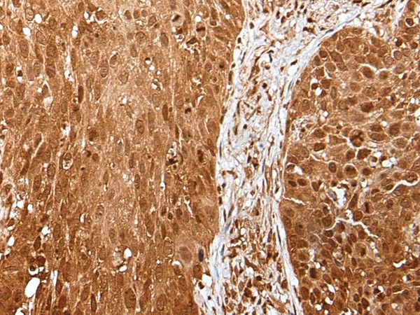 Immunohistochemistry of paraffin-embedded Human lung cancer tissue  using UBA7 Polyclonal Antibody at dilution of 1:35(?200)