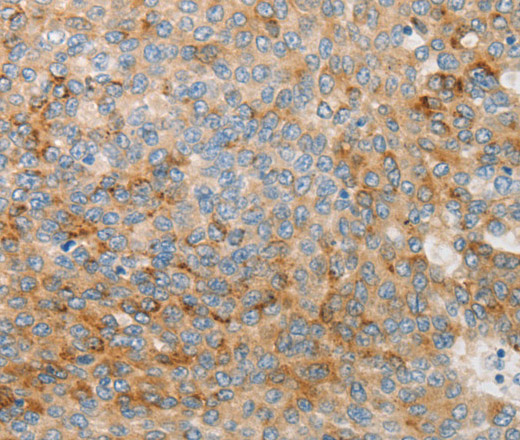 Immunohistochemistry of paraffin-embedded Human liver cancer using IGFBP1 Polyclonal Antibody at dilution of 1:30