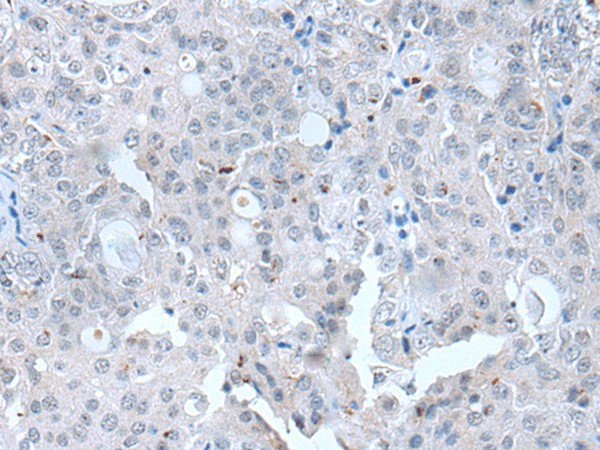 Immunohistochemistry of paraffin-embedded Human ovarian cancer tissue  using CLDN12 Polyclonal Antibody at dilution of 1:45(?200)