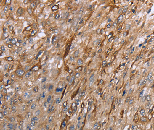 Immunohistochemistry of paraffin-embedded Human esophagus cancer using GRPR Polyclonal Antibody at dilution of 1:40