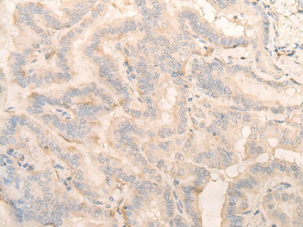 Immunohistochemistry of paraffin-embedded Human thyroid cancer tissue  using PITPNB Polyclonal Antibody at dilution of 1:25(?200)