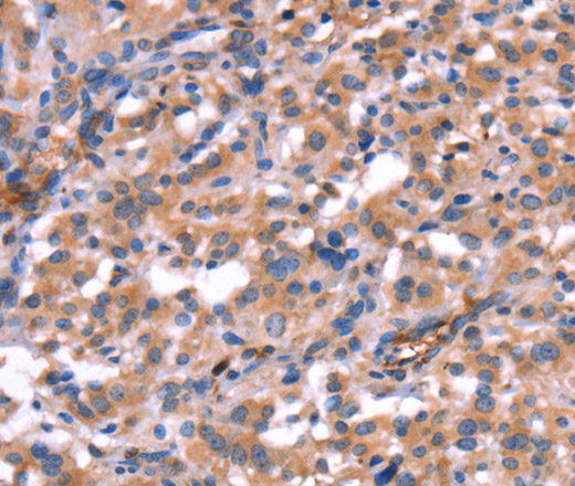 Immunohistochemistry of paraffin-embedded Human thyroid cancer using HMGCS1 Polyclonal Antibody at dilution of 1:40