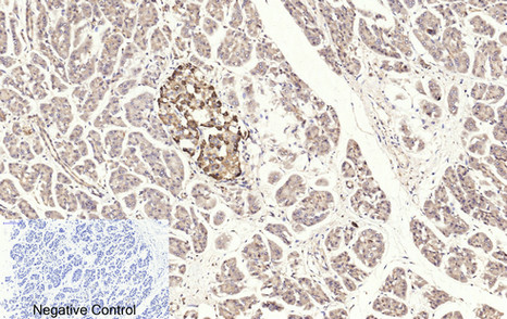 Immunohistochemistry of paraffin-embedded Human stomach cancer tissue using Cleaved-CASP3 p17 (D175) Polyclonal Antibody at dilution of 1:200.